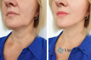 Double chin before and after Hi-Fu treatment 4 Book your double chin treatment Hickstead today! We are here to help!