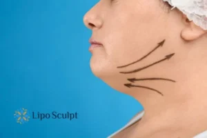 Double chin before and after Hi-Fu treatment 3 Boost your confidence with a Double chin treatment Hickstead