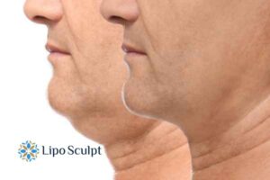 Double chin before and after Hi-Fu treatment 2 Double chin treatment Hickstead from Lipo Sculpt - feel more confident today!