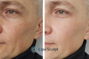 How to Fight Aging Symptoms 3 Fight Aging Symptoms Hickstead With HIFU and Morpheus8 Today!