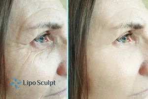 How to Fight Aging Symptoms 2 Do you want to Fight Aging Symptoms Hickstead? Contact Lipo Sculpt today!