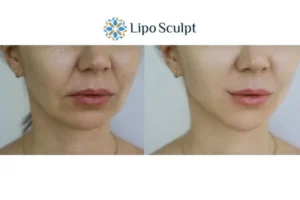 Explaining Total Skin Tightening Treatment And What It Can Do For You 2 Do you want to boost your self confidence? Give Morpheus8 Hickstead a try today!