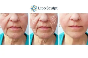 Explaining Total Skin Tightening Treatment And What It Can Do For You 3 Boost your confidence with Morpheus8 Hickstead call our team today!
