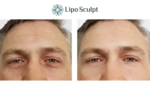 Explaining Total Skin Tightening Treatment And What It Can Do For You 6 Morpheus8 Hickstead book in today to find out more!