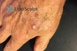 Best Actinic Keratoses Removal 2 Improve your wellbeing and health with Actinic Keratoses Hickstead removal.treatment
